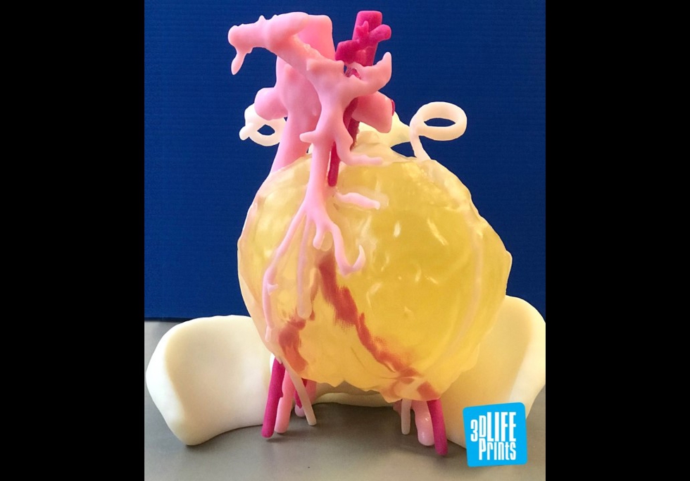 3D LifePrints 3D printed tumour