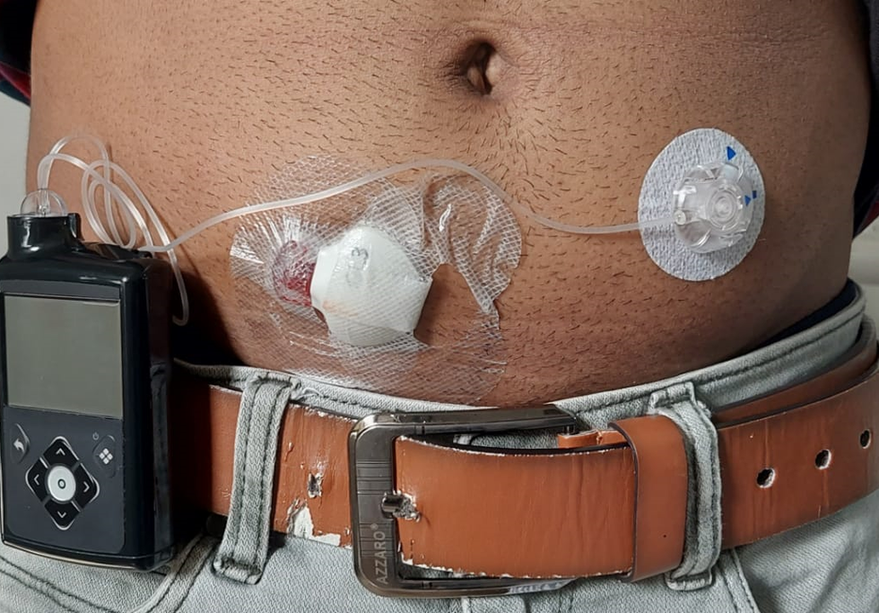 Artificial pancreas installed by Jothydev's. Credit: Jothydev's Diabetes &amp; Research Centre